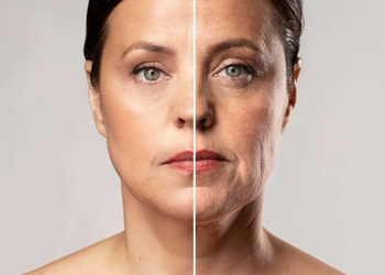 Skin Tightening