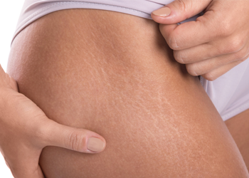 Microneedling for scars and strechmarks